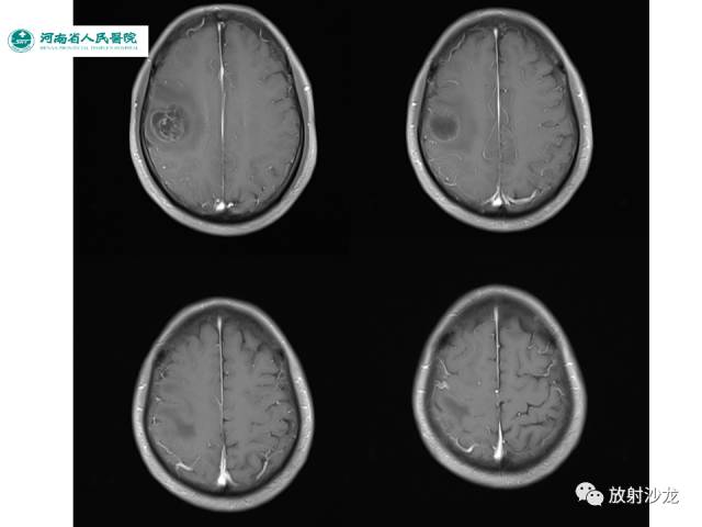 【病例】成人幕上毛细胞型星形细胞瘤1例MR