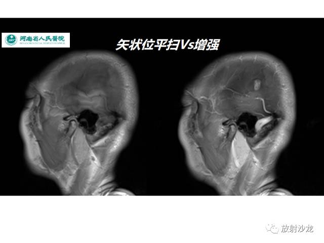 【病例】成人幕上毛细胞型星形细胞瘤1例MR