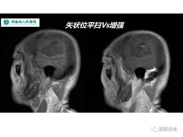 【病例】成人幕上毛细胞型星形细胞瘤1例MR