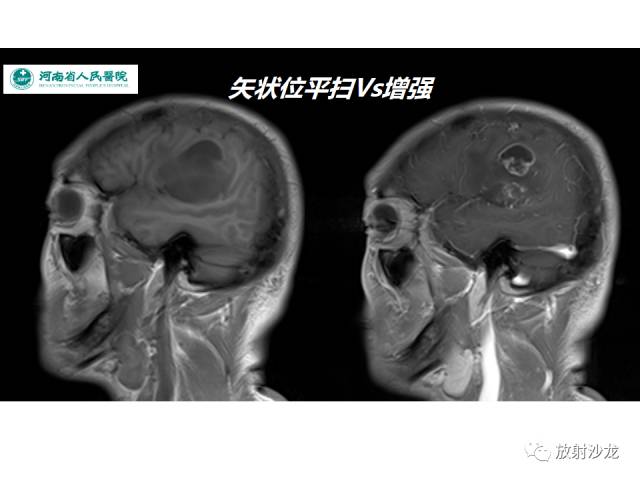 【病例】成人幕上毛细胞型星形细胞瘤1例MR