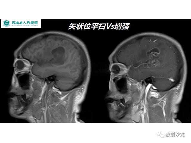 【病例】成人幕上毛细胞型星形细胞瘤1例MR