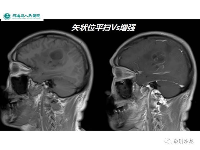 【病例】成人幕上毛细胞型星形细胞瘤1例MR