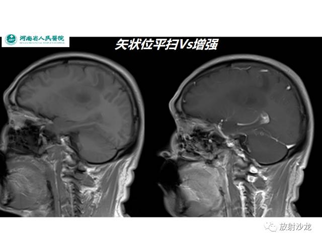 【病例】成人幕上毛细胞型星形细胞瘤1例MR