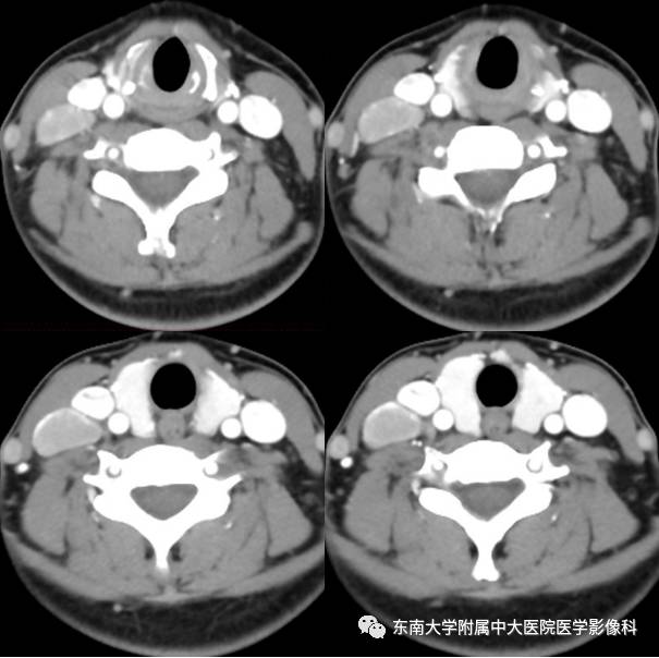 【病例】颈部巨淋巴结增生症1例CT影像表现