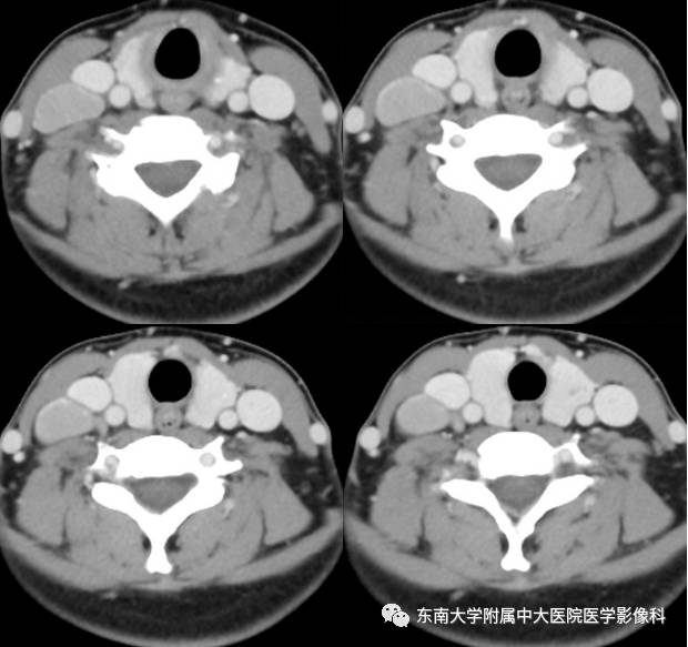 【病例】颈部巨淋巴结增生症1例CT影像表现