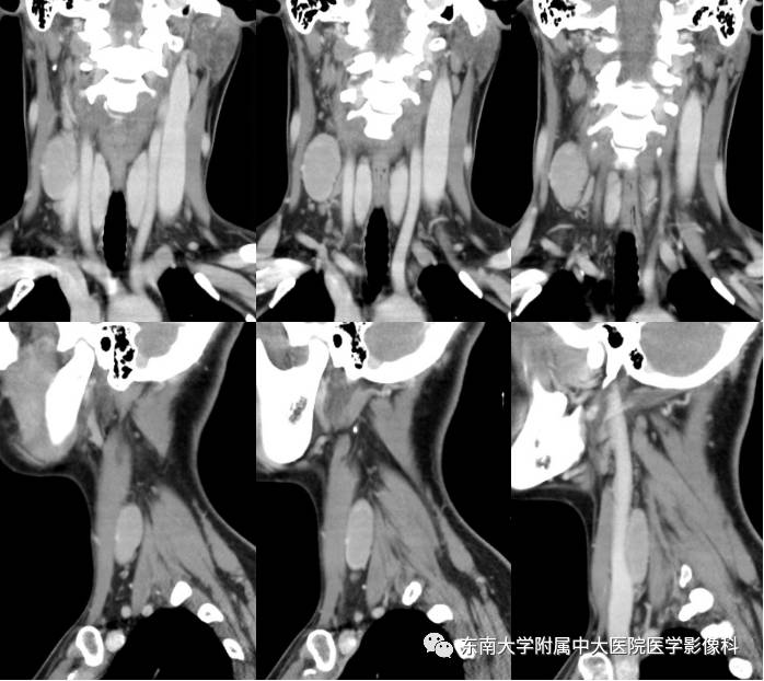 【病例】颈部巨淋巴结增生症1例CT影像表现