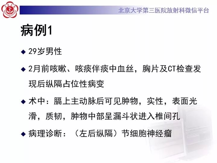 【病例】纵隔神经节细胞神经瘤2例影像诊断
