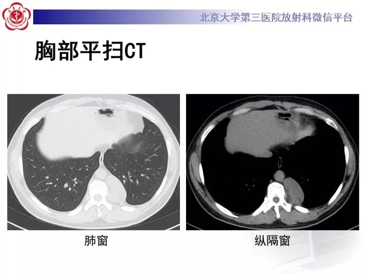 【病例】纵隔神经节细胞神经瘤2例影像诊断