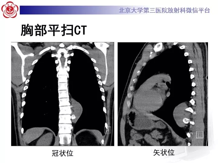【病例】纵隔神经节细胞神经瘤2例影像诊断