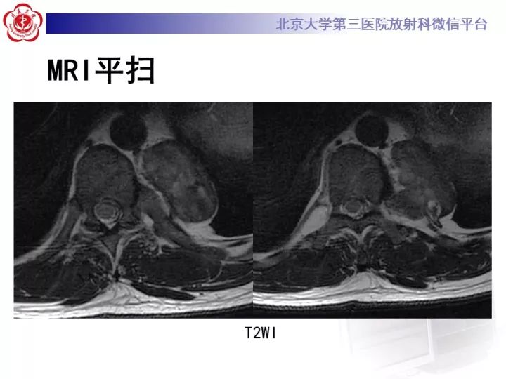 【病例】纵隔神经节细胞神经瘤2例影像诊断
