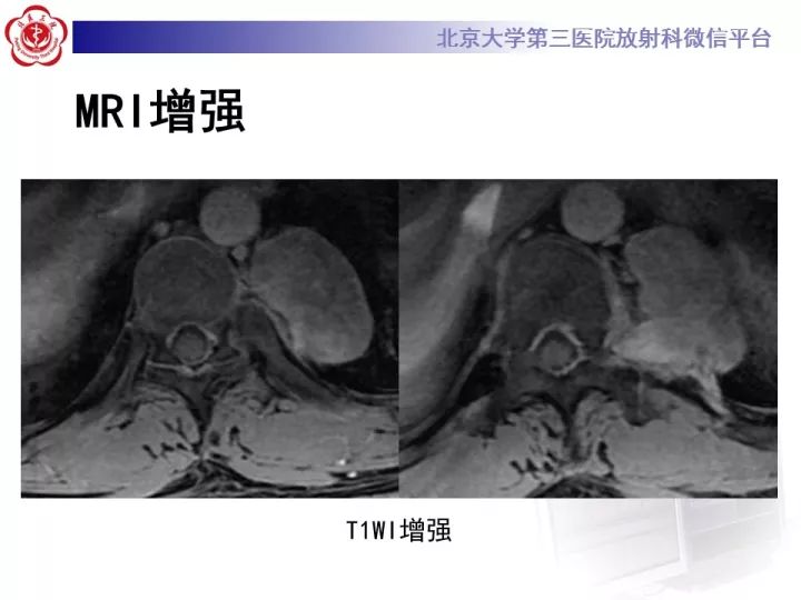 【病例】纵隔神经节细胞神经瘤2例影像诊断