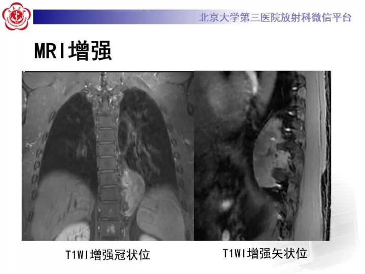 【病例】纵隔神经节细胞神经瘤2例影像诊断