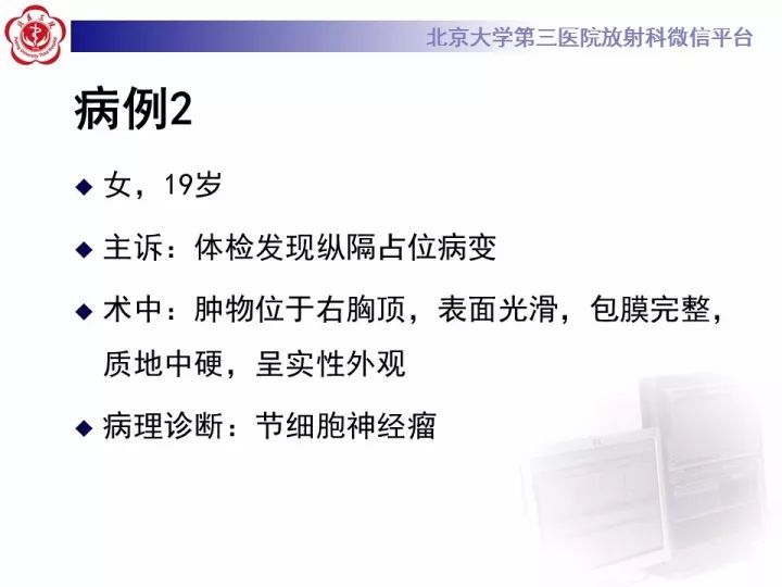 【病例】纵隔神经节细胞神经瘤2例影像诊断