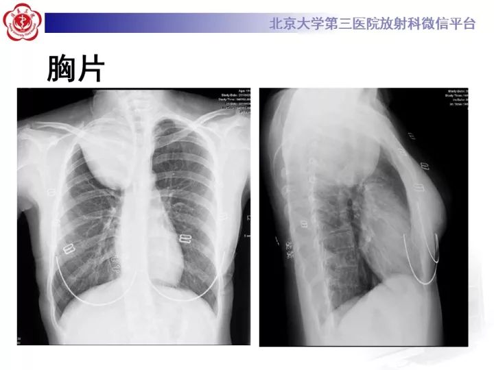 【病例】纵隔神经节细胞神经瘤2例影像诊断