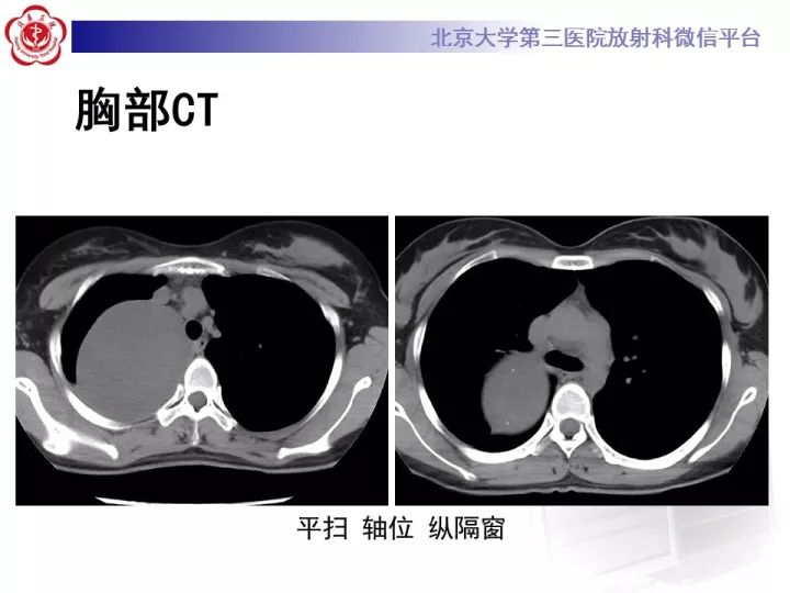 【病例】纵隔神经节细胞神经瘤2例影像诊断