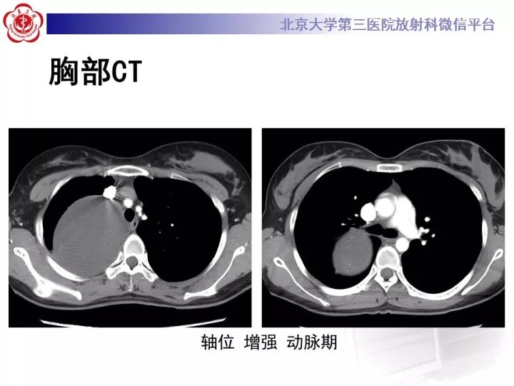 【病例】纵隔神经节细胞神经瘤2例影像诊断