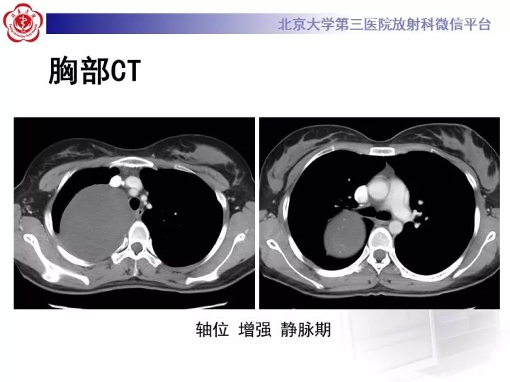 【病例】纵隔神经节细胞神经瘤2例影像诊断