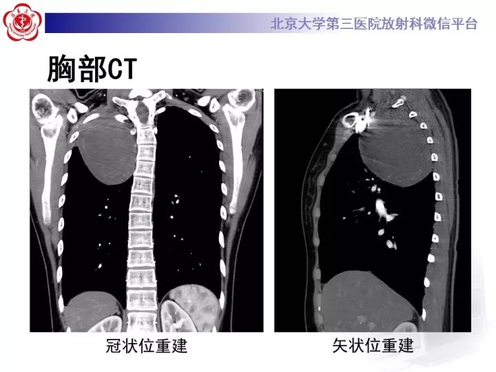【病例】纵隔神经节细胞神经瘤2例影像诊断