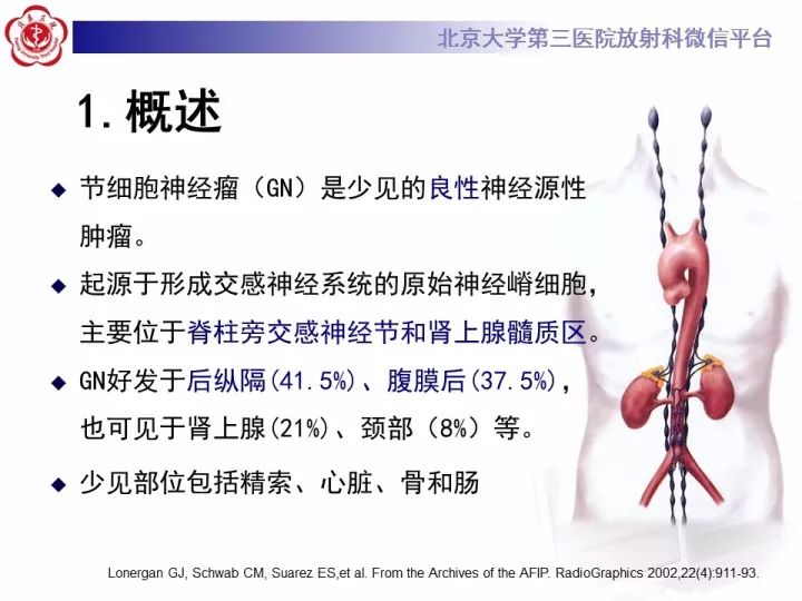 【病例】纵隔神经节细胞神经瘤2例影像诊断