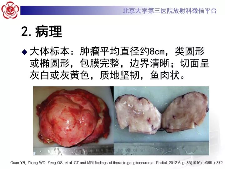 【病例】纵隔神经节细胞神经瘤2例影像诊断