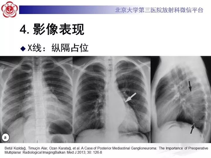 【病例】纵隔神经节细胞神经瘤2例影像诊断