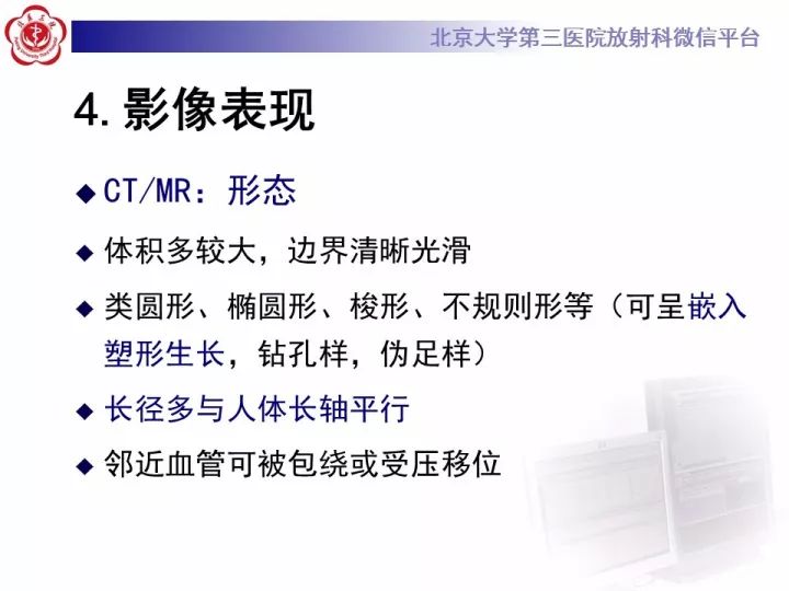【病例】纵隔神经节细胞神经瘤2例影像诊断