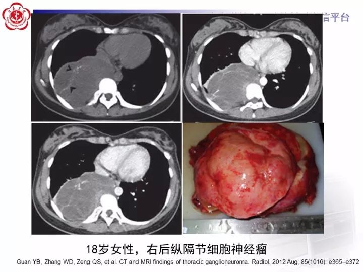 【病例】纵隔神经节细胞神经瘤2例影像诊断