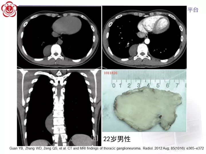 【病例】纵隔神经节细胞神经瘤2例影像诊断