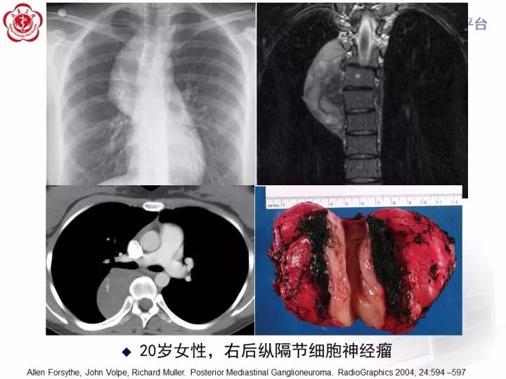 【病例】纵隔神经节细胞神经瘤2例影像诊断