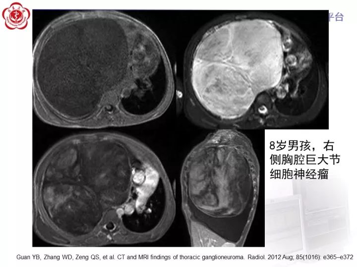 【病例】纵隔神经节细胞神经瘤2例影像诊断