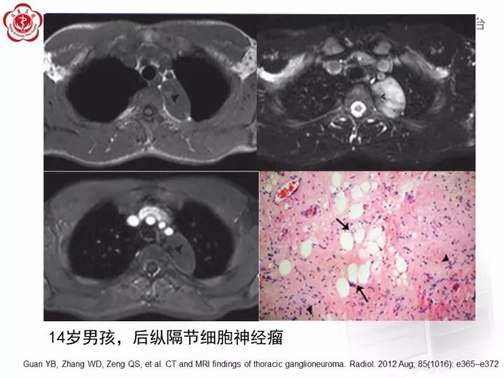 【病例】纵隔神经节细胞神经瘤2例影像诊断