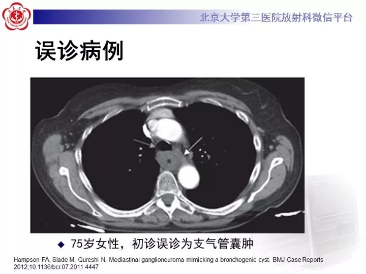 【病例】纵隔神经节细胞神经瘤2例影像诊断