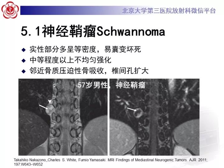 【病例】纵隔神经节细胞神经瘤2例影像诊断