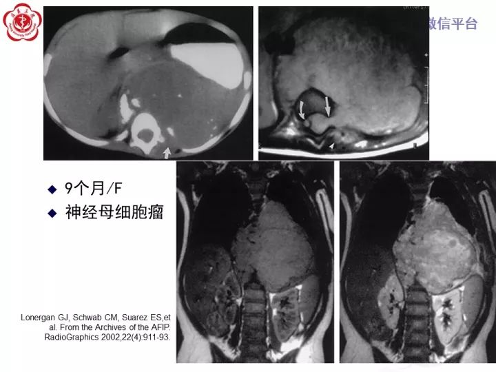 【病例】纵隔神经节细胞神经瘤2例影像诊断