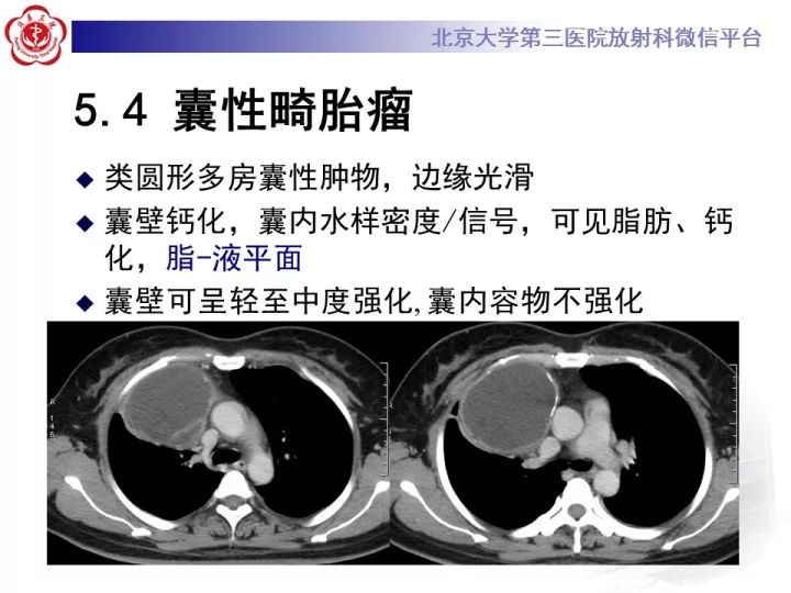 【病例】纵隔神经节细胞神经瘤2例影像诊断