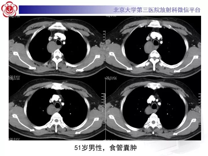【病例】纵隔神经节细胞神经瘤2例影像诊断