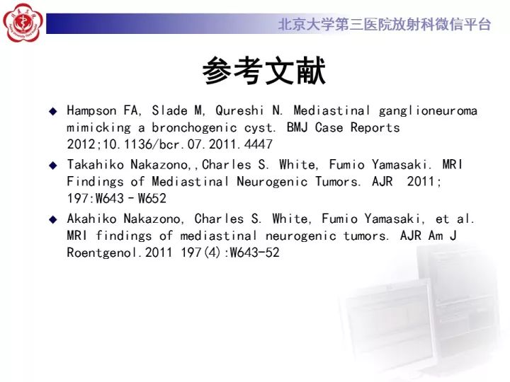【病例】纵隔神经节细胞神经瘤2例影像诊断