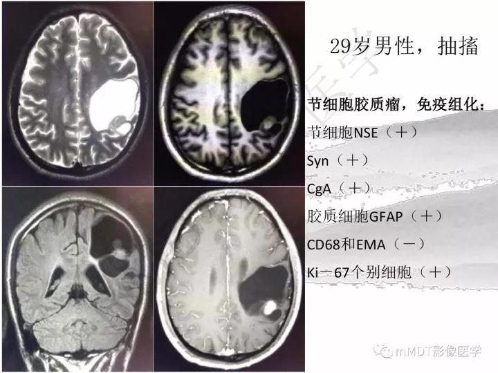 【PPT】颅内节细胞胶质瘤的MR诊断