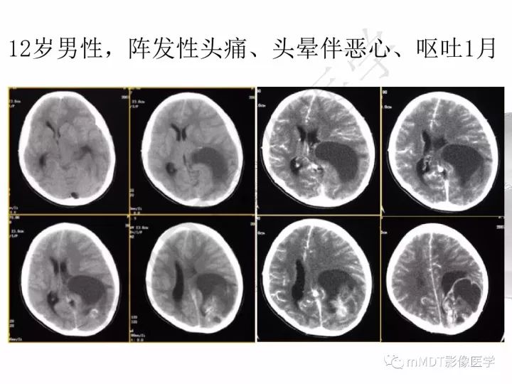 【PPT】颅内节细胞胶质瘤的MR诊断