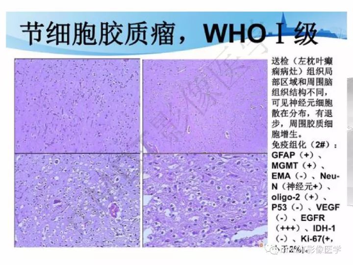 【PPT】颅内节细胞胶质瘤的MR诊断