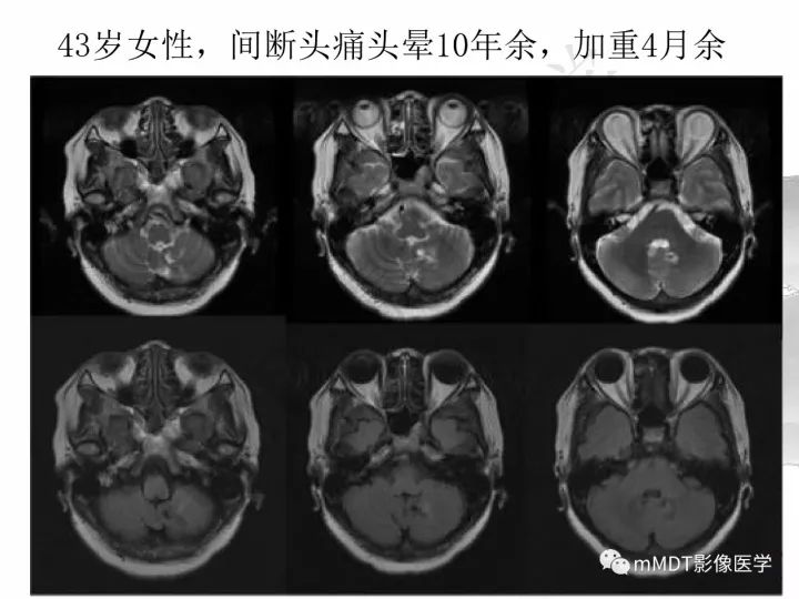 【PPT】颅内节细胞胶质瘤的MR诊断