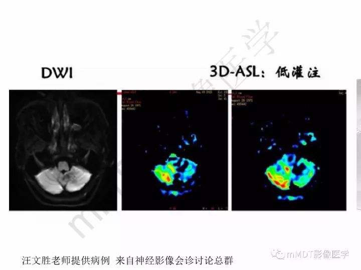 【PPT】颅内节细胞胶质瘤的MR诊断