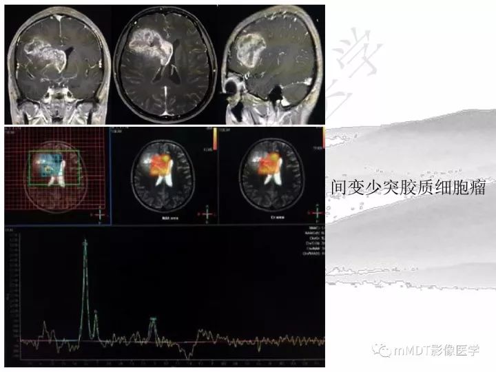 【PPT】颅内节细胞胶质瘤的MR诊断