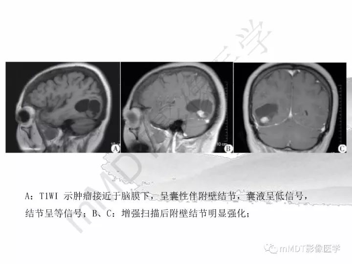 【PPT】颅内节细胞胶质瘤的MR诊断