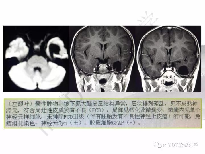 【PPT】颅内节细胞胶质瘤的MR诊断