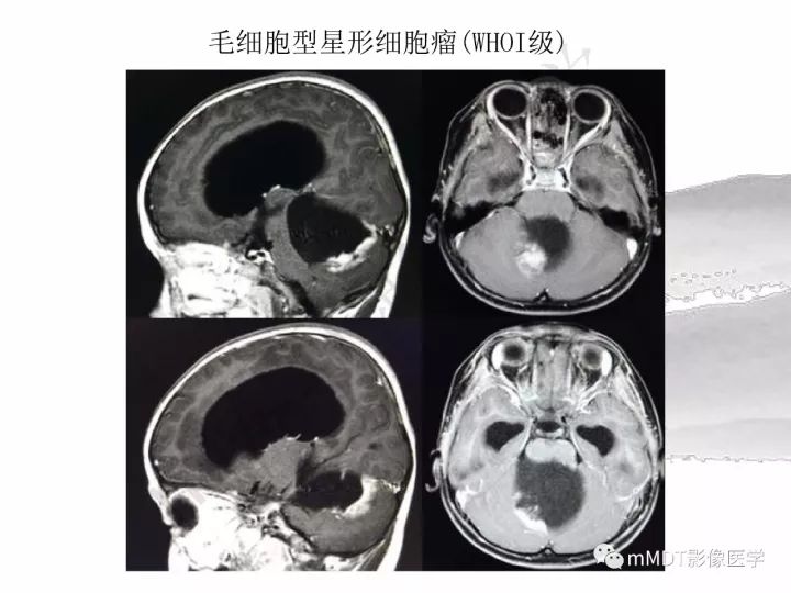 【PPT】颅内节细胞胶质瘤的MR诊断