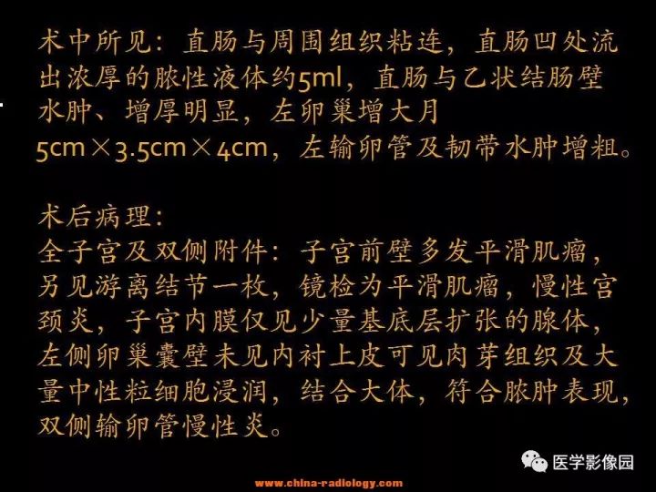 【病例】盆腔脓肿1例MR