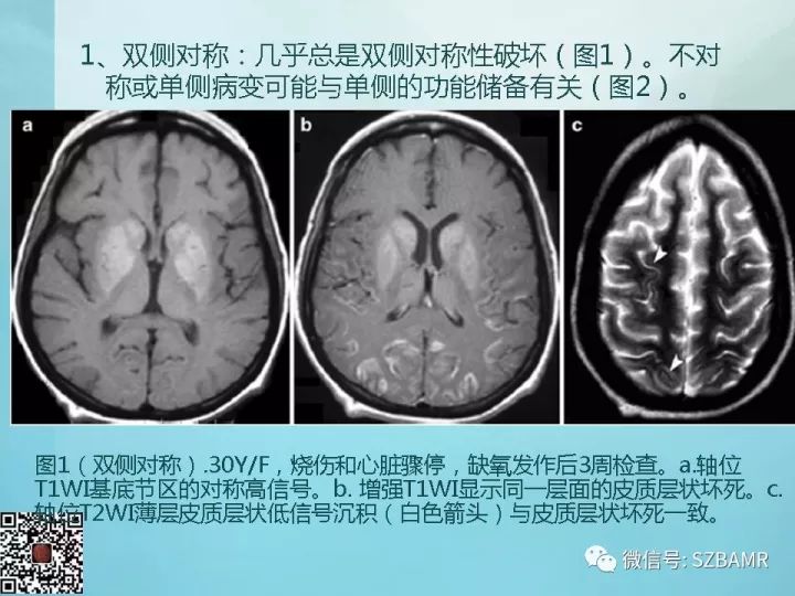 【PPT】非新生儿缺氧缺血性脑病的病理生理学改变及CT和MRI表现