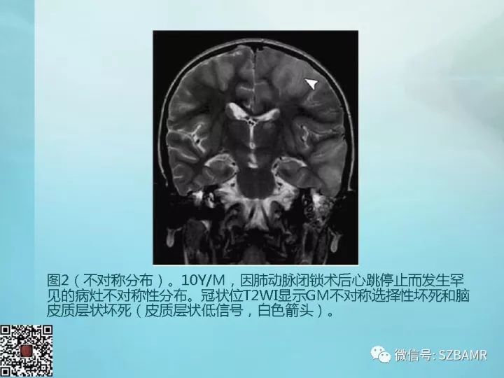 【PPT】非新生儿缺氧缺血性脑病的病理生理学改变及CT和MRI表现