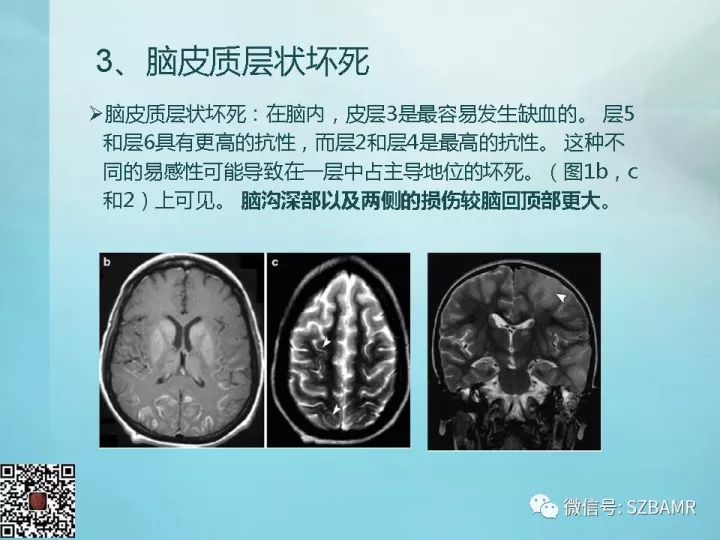 【PPT】非新生儿缺氧缺血性脑病的病理生理学改变及CT和MRI表现